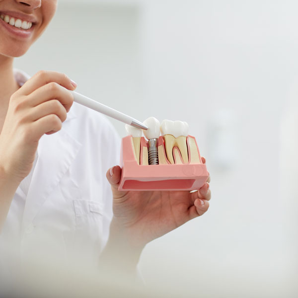 dental implant