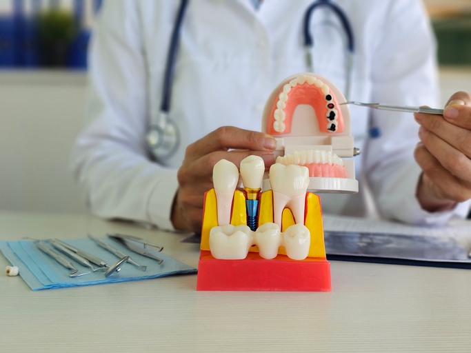 Doctor demonstrating dental implant process in Brecksville & nearby areas
