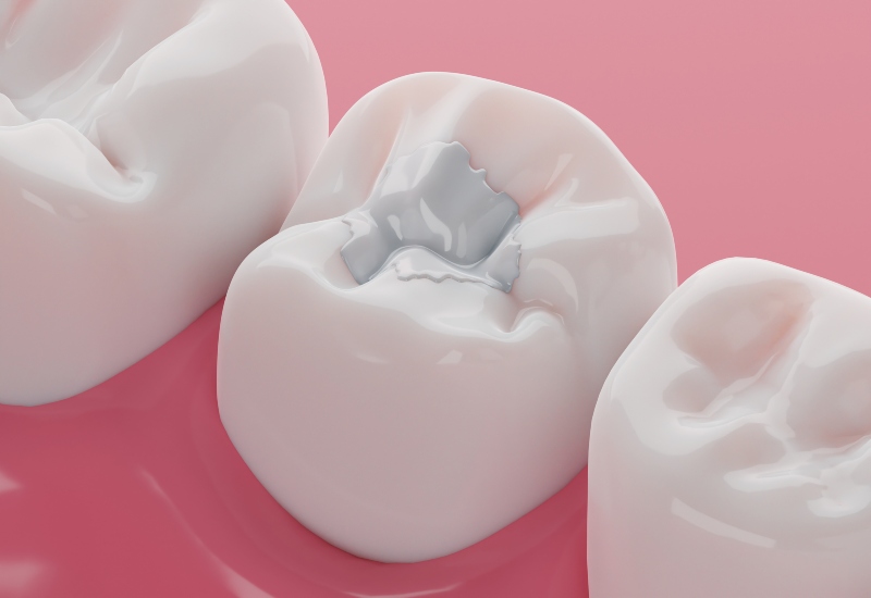 3D illustration of cavity restoration with a Dental Filling in Brecksville, OH & nearby areas