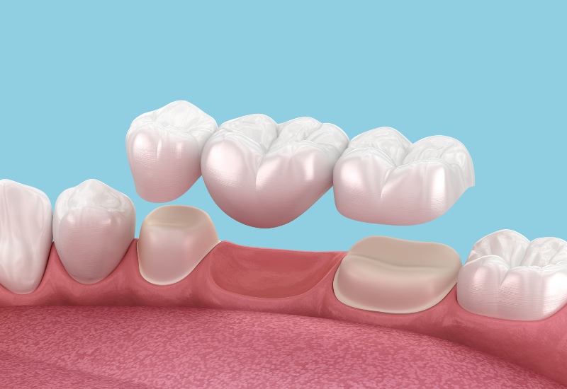 3D illustration of a Dental Bridge above two prepared teeth in Brecksville, OH & nearby areas